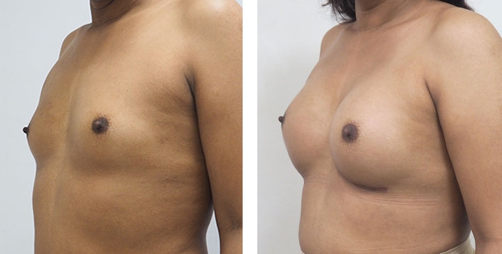 Augmentation Mammaire de Masculin à Féminin 5 lg 6494958a0d1d6 image
