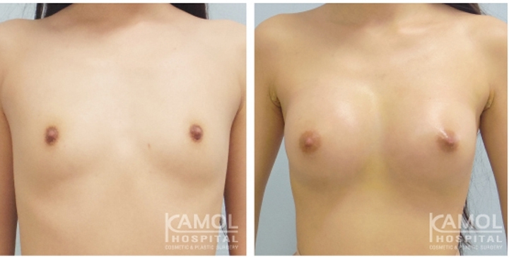 Male to Female Breast Augmentation 8 lg 6494958a2c22a image