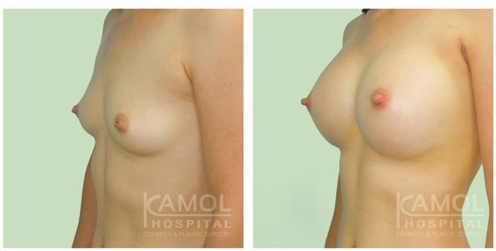 Male to Female Breast Augmentation 9 lg 6494958a3c3f7 image