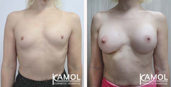 Male to Female Breast Augmentation 16 lg 66387d45eb844 image