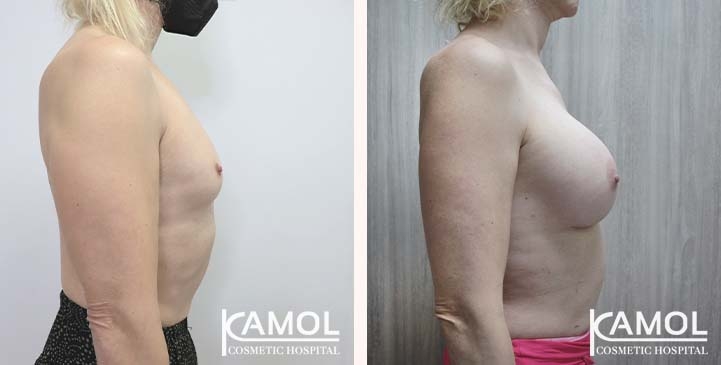Male to Female Breast Augmentation 15 lg 66387d461deb6 image