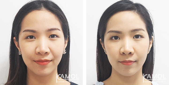 جراحة تضييق فتحتي الأنف 9 Before & After Alarplasty