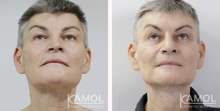 Chirurgie de Masculinisation du Visage / FMS 10 lg 6494959928cc9 image