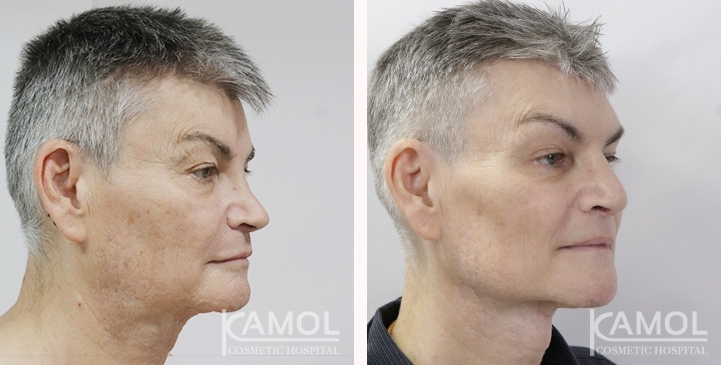 Chirurgie de Masculinisation du Visage / FMS 11 lg 649495992ac4d image