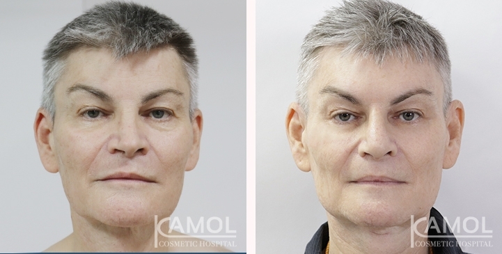 Chirurgie de Masculinisation du Visage / FMS 12 lg 649495992ca6c image