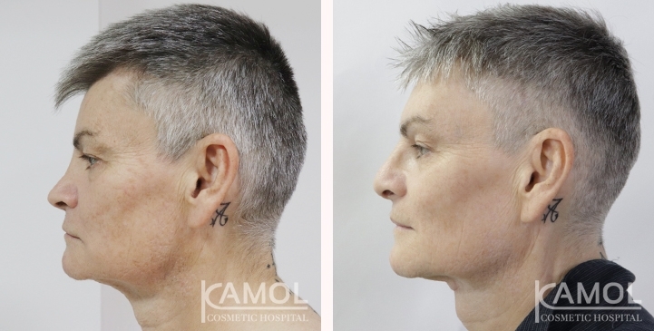 Chirurgie de Masculinisation du Visage / FMS 14 lg 64949599304e7 image