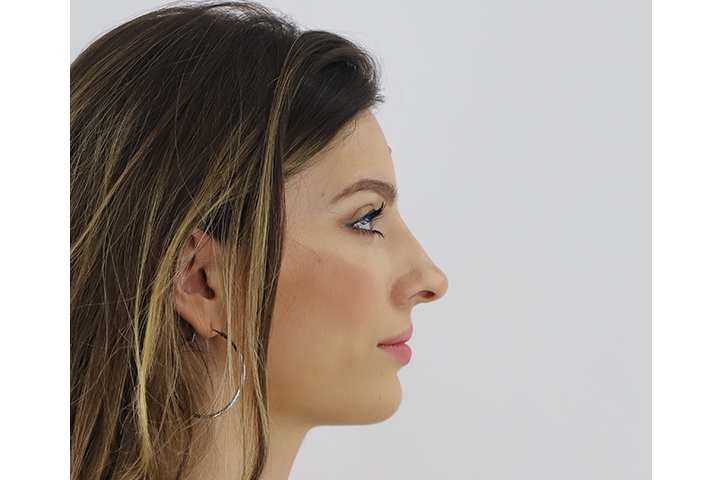 تجميل الأنف / عملية تجميل الأنف 18 lg 649f88943eef1 image