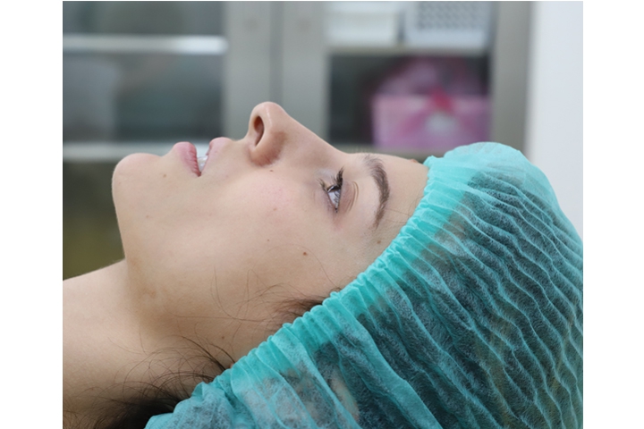 تجميل الأنف / عملية تجميل الأنف 25 Revision Rhinoplasty