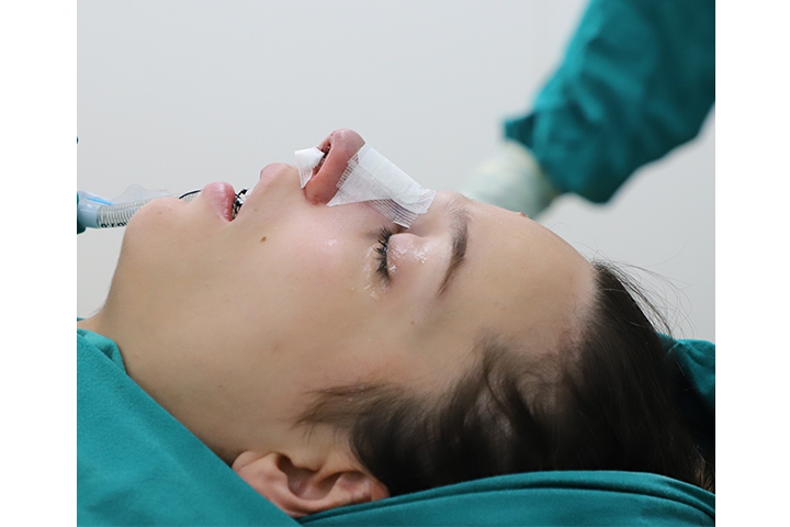 تجميل الأنف / عملية تجميل الأنف 21 Revision Rhinoplasty