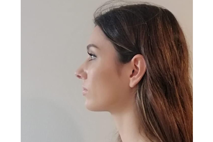 تجميل الأنف / عملية تجميل الأنف 19 Revision Rhinoplasty