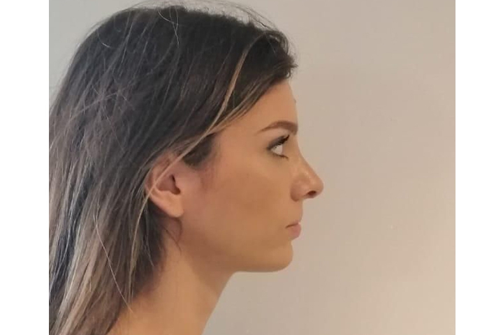 تجميل الأنف / عملية تجميل الأنف 20 lg 649f88944c9eb image