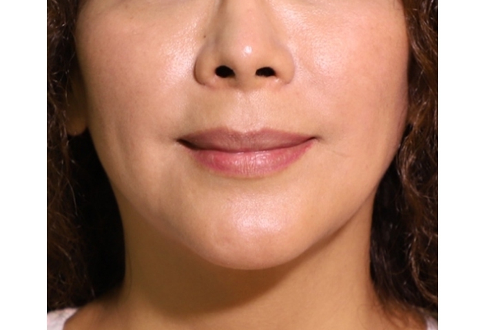 Cirurgia Labial 30 lg 649f889567316 image