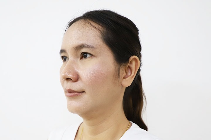 耳形成術 / 扇耳 13 lg 649f88957f20a image