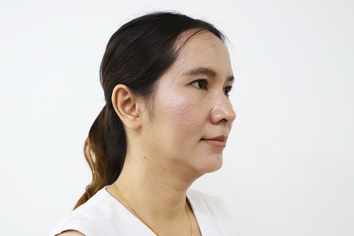 耳形成術 / 扇耳 15 lg 649f889581e23 image