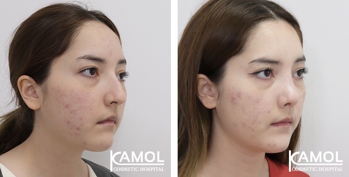 تجميل الأنف / عملية تجميل الأنف 13 lg 67541e82e804e image