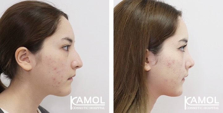 تجميل الأنف / عملية تجميل الأنف 16 lg 675424dfb91a7 image