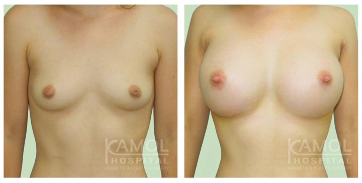 Cirurgia de Mama para Mulheres Trans 29 BreastAugmentation 7 1