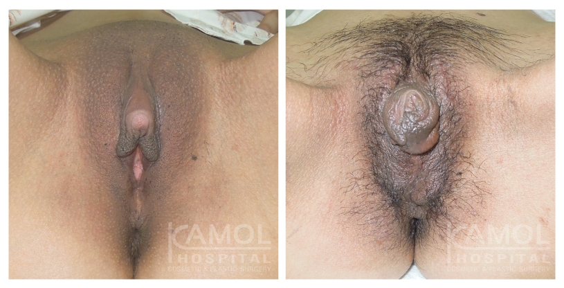 استئصال العضو التناسلي الصغير 21 Metoidioplasty 6 1
