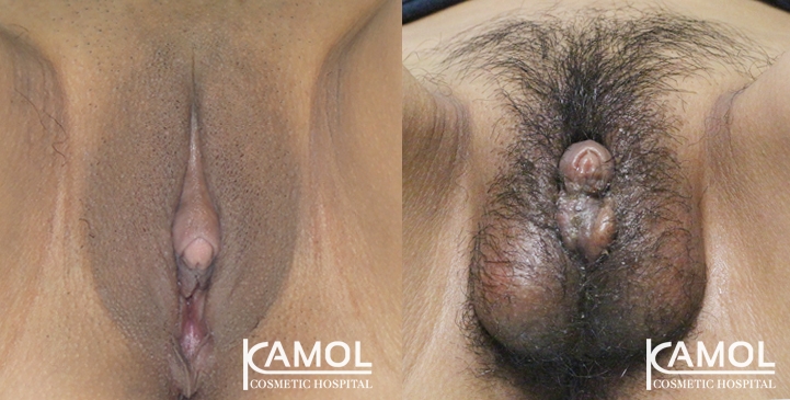 استئصال العضو التناسلي الصغير 23 Metoidioplasty 7 1