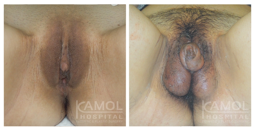 استئصال العضو التناسلي الصغير 25 Metoidioplasty 8 1
