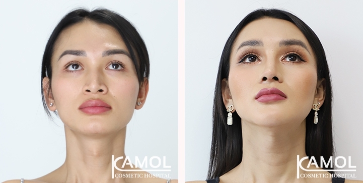 Cirurgia de Feminização Facial / FFS 5 lg 6494958982f75 image