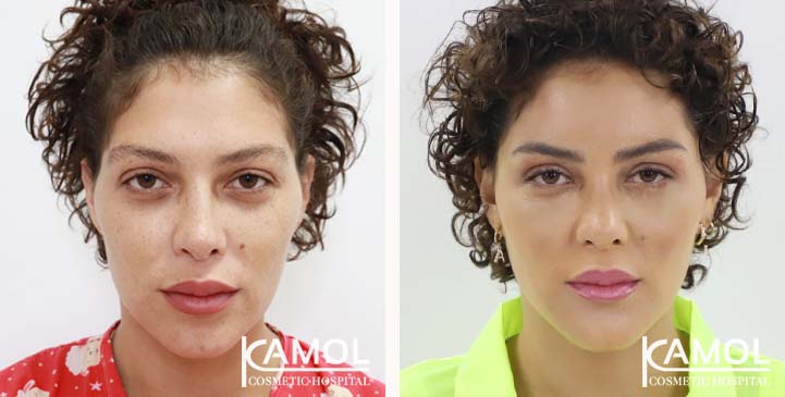 Cirurgia de Feminização Facial / FFS 9 lg 6494958985905 image
