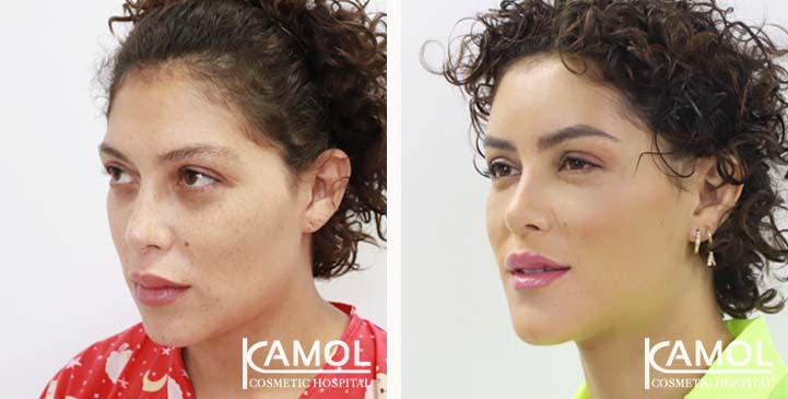Cirurgia de Feminização Facial / FFS 10 lg 64949589877f2 image