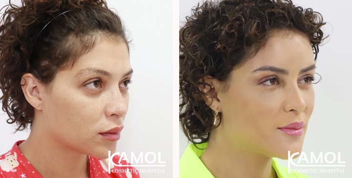 Cirurgia de Feminização Facial / FFS 11 lg 649495898940b image