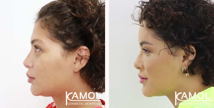 Cirurgia de Feminização Facial / FFS 12 lg 649495898b1db image