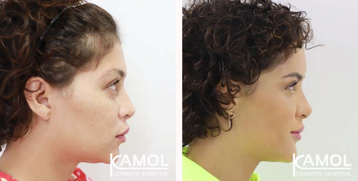 Cirurgia de Feminização Facial / FFS 13 lg 649495898cf23 image