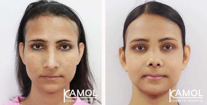 Cirurgia de Feminização Facial / FFS 15 lg 649495898f9ad image