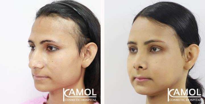 Cirurgia de Feminização Facial / FFS 16 lg 64949589917ce image