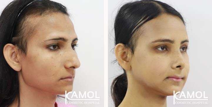 Cirurgia de Feminização Facial / FFS 17 lg 649495899373c image
