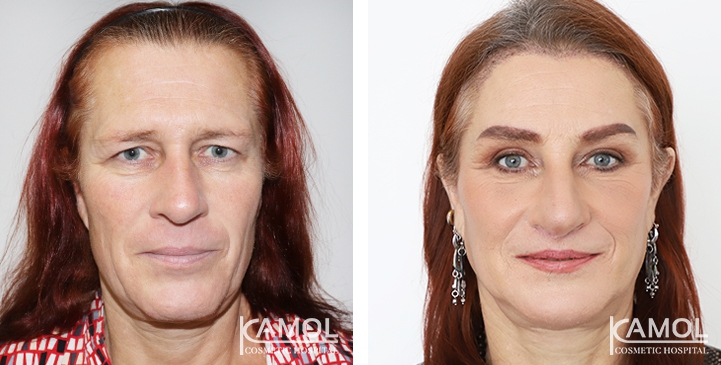 Cirurgia de Feminização Facial / FFS 20 lg 6494958997d4d image