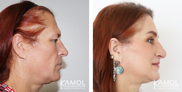 Cirurgia de Feminização Facial / FFS 23 lg 649495899c3e0 image