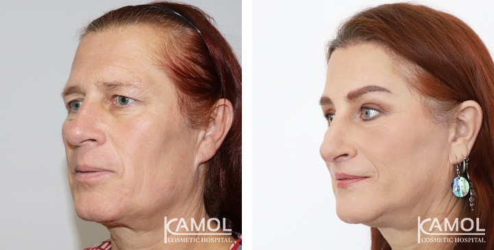 Cirurgia de Feminização Facial / FFS 24 lg 649495899e497 image