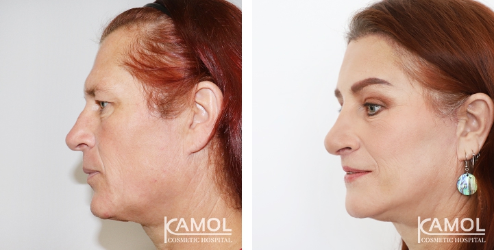 Cirurgia de Feminização Facial / FFS 21 lg 64949589a06cc image