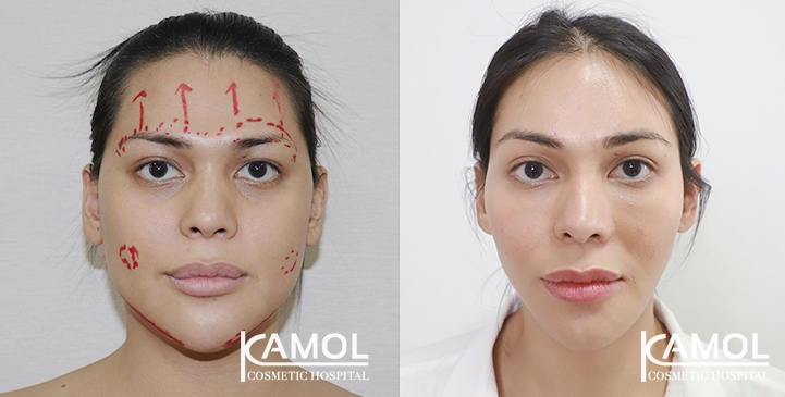 Cirurgia de Feminização Facial / FFS 26 lg 64949589a31b0 image