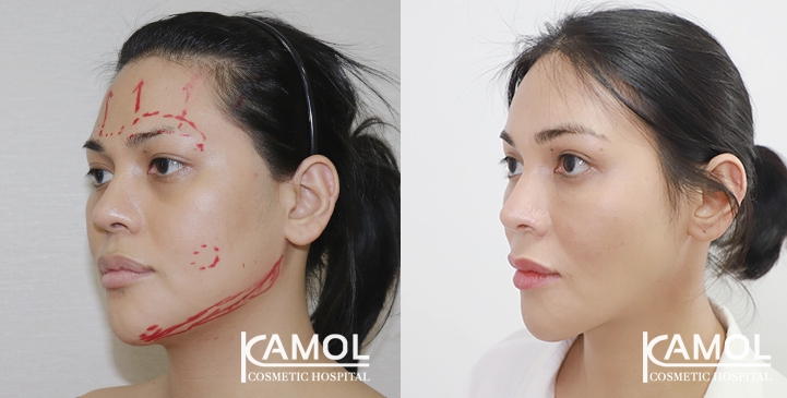 Cirurgia de Feminização Facial / FFS 27 lg 64949589a4ff8 image