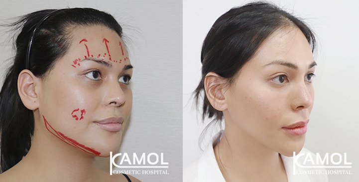 Cirurgia de Feminização Facial / FFS 28 lg 64949589a6f34 image