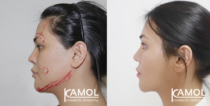 Cirurgia de Feminização Facial / FFS 29 lg 64949589a8cfd image