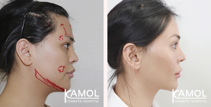 Cirurgia de Feminização Facial / FFS 30 lg 64949589aae6c image