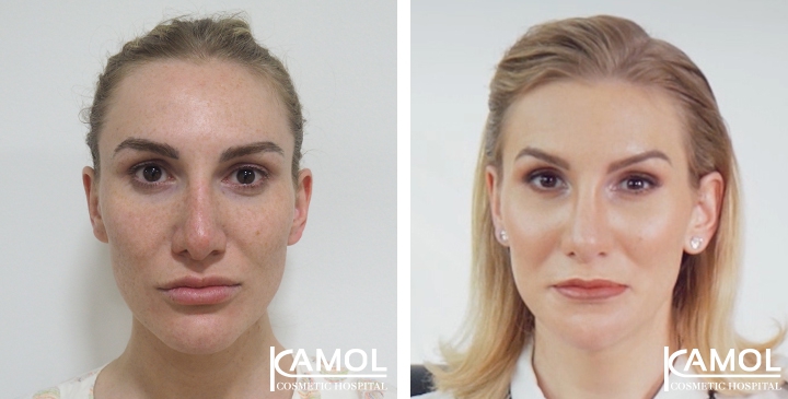 Cirurgia de Feminização Facial / FFS 32 lg 64949589b114a image