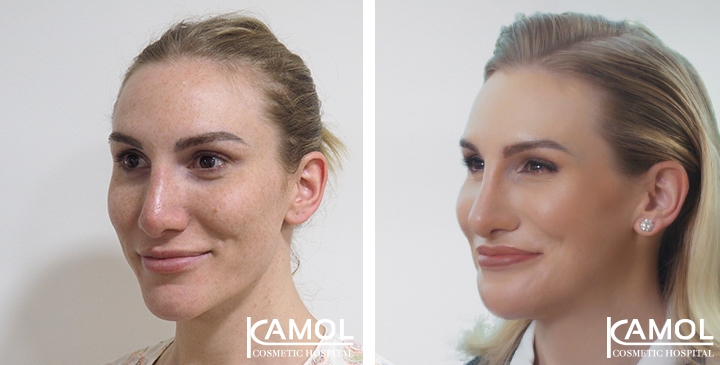 Cirurgia de Feminização Facial / FFS 36 lg 64949589b3103 image