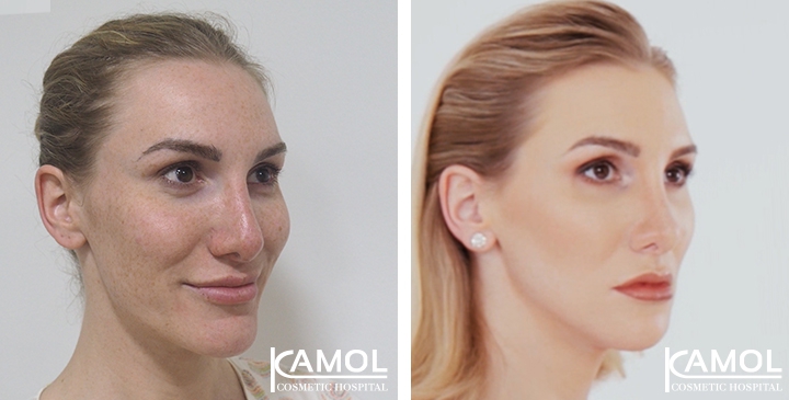 Cirurgia de Feminização Facial / FFS 34 lg 64949589b6d87 image
