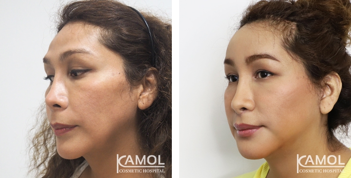 Cirurgia de Feminização Facial / FFS 58 lg 64949589d2361 image