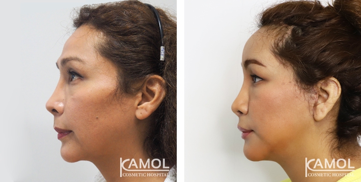 Cirurgia de Feminização Facial / FFS 57 lg 64949589d42b3 image
