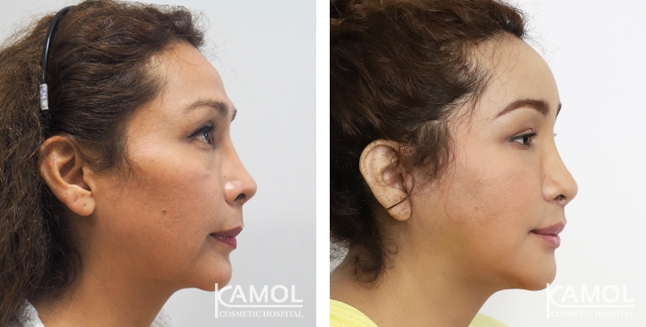 Cirurgia de Feminização Facial / FFS 60 lg 64949589da013 image