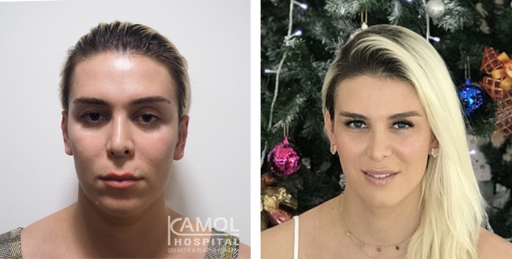 Cirurgia de Feminização Facial / FFS 62 lg 64949589dcb82 image