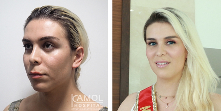 Cirurgia de Feminização Facial / FFS 63 lg 64949589dead0 image